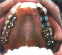 Krankmachendes Amalgam