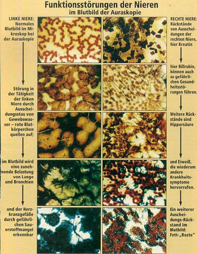 Funktionsstörungen der Nierenim Blutbild der Auraskopie