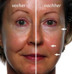 vorher - nachher