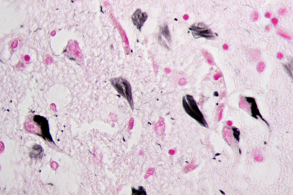 Alzheimer-Fibrillen - die Tau-Fibrillen