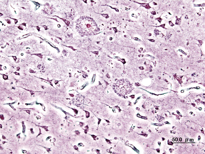 Alzheimer-Plaques